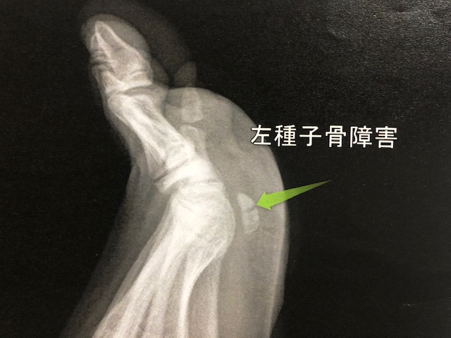 種子骨障害を治す
